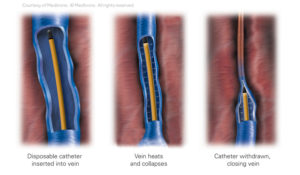 Radio Frequency Endovenous Ablation in Norfolk - Specialty Vein Care