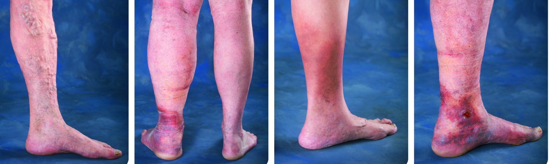Chronic Venous Insufficiency Patient Norfolk, MA - Specialty Vein Care